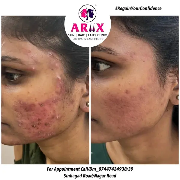 Acne Control Treatment Results