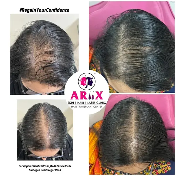 Female Hair Restoration Results