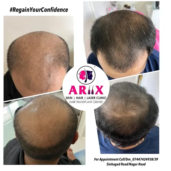 Advanced Hair Transplantation Results