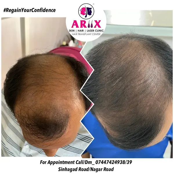 Crown Hair Restoration Results