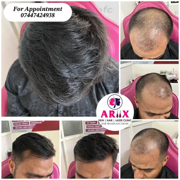 Advanced Hair Restoration Results