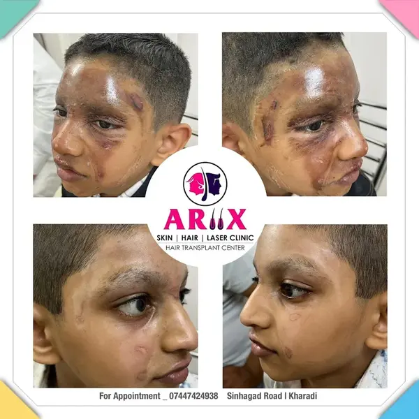 Scar Treatment & Skin Healing Results